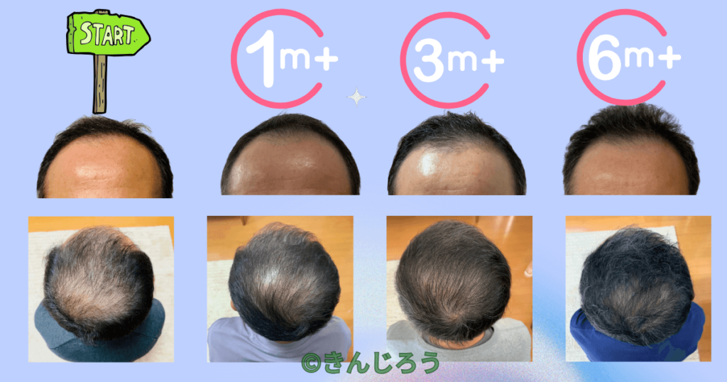 6month-after-minoxidil